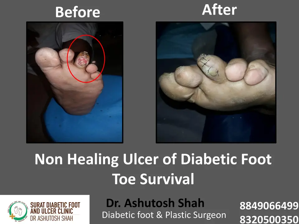 Diabetic Foot  PPT 3 checked by sir.pptx-66.webp